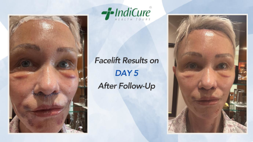 Facelift Surgery in India Results Day 5